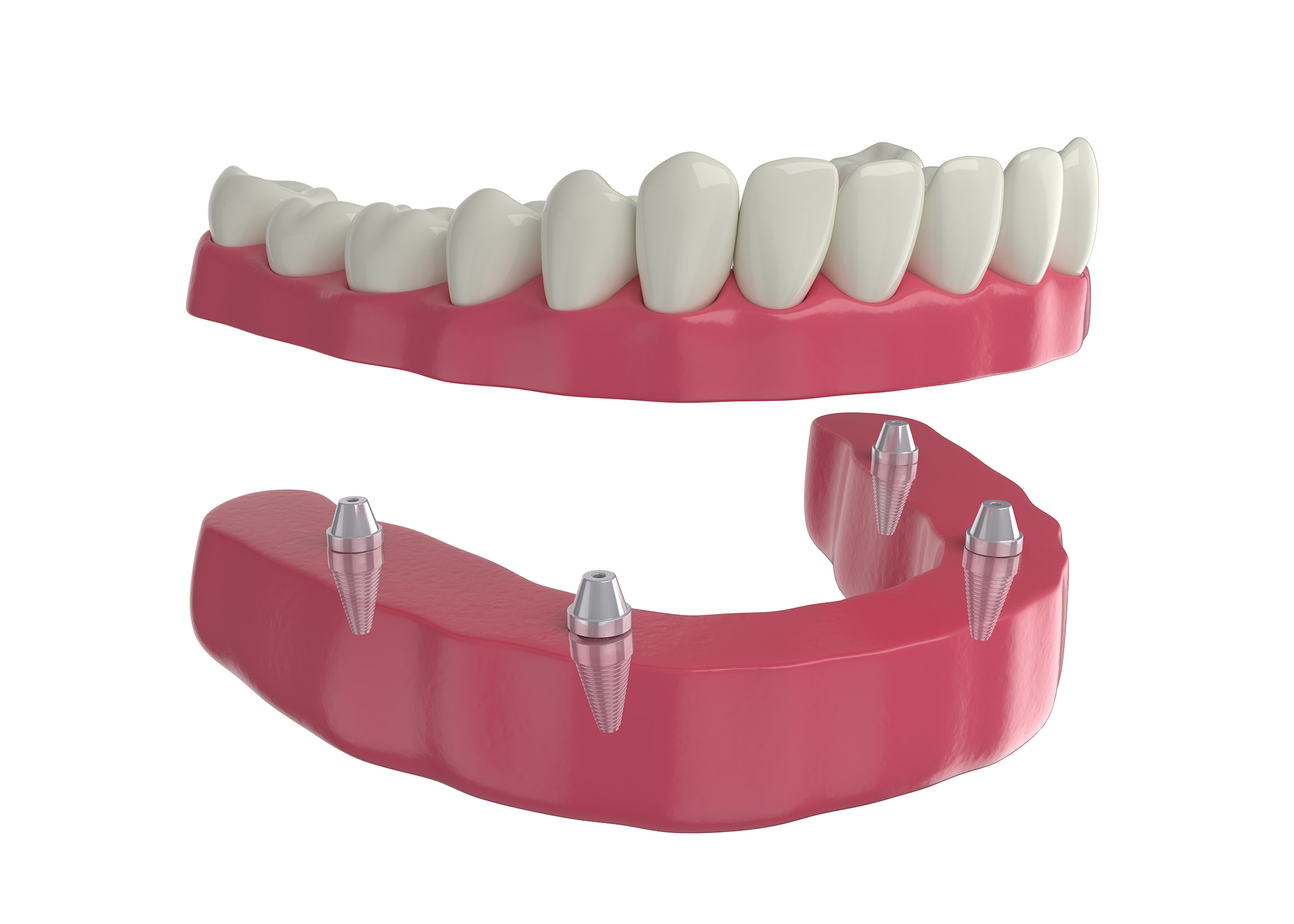 Restauração dentária