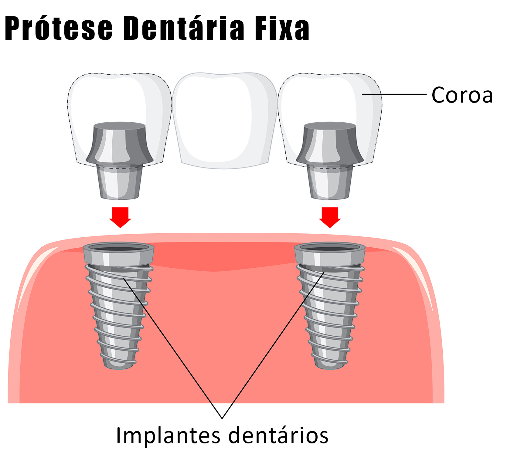 Restauração dentária
